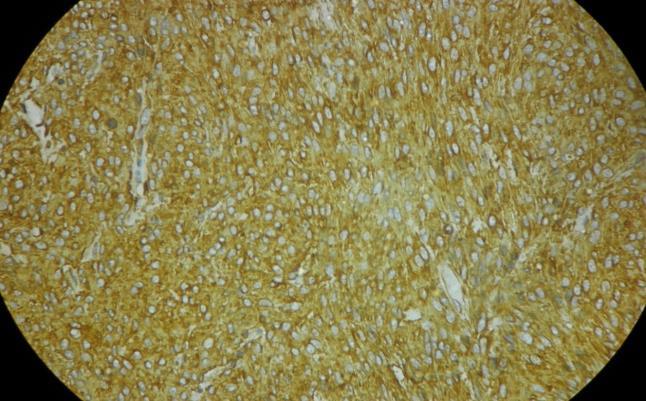 In present study, 1 case of Anaplastic Dysgerminoma was found, IHC study shows Vimentin (+), PLAP (+), CD117 (+), while CK (-), LCA (-), S-100 (-), CD30 (-).