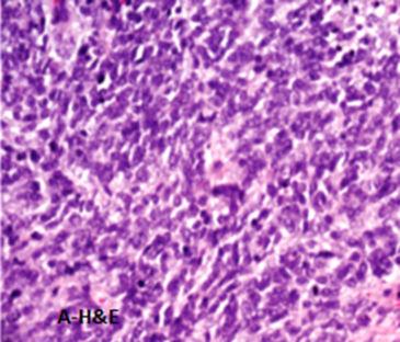 Figure 1A Undifferentiated ovarian carcinoma (H&E staining, x200). Figure 1C Cytokeratin AE1/AE3 strong positivity of the tumor cells (CKAE1/AE3, x200).