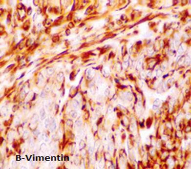 The positive staining was uniformly distributed in the cytoplasm of tumor stromal cells and it ranged from moderate to strong positive (Figure 1B).