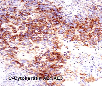 EMA antibody EMA reaction was diffusely positive in eighteen cases.