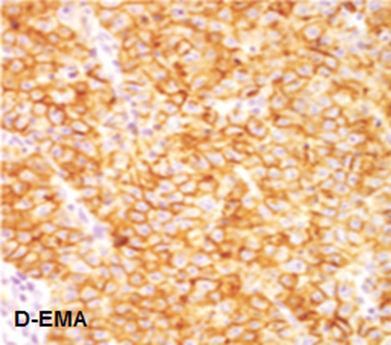 The intensity of immunostaining ranged from moderate to strong positive. Again the same two negative cases for CK AE1/AE3 were also negative for EMA, which suggested it is not epithelial in origin.