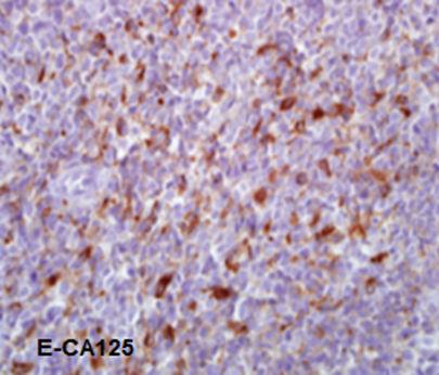 strong intensity with membranous and cytoplasmic pattern (Figure 1E). Figure 1E CA125 positive cytoplasmic and membranous reaction of the tumor cells (CA125, x200).