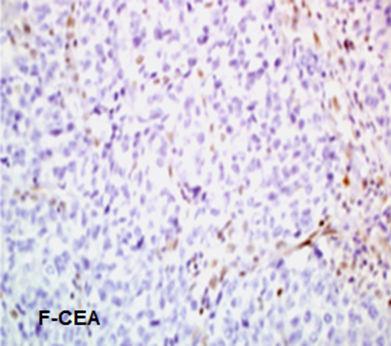 The distribution of CEA staining was focal, weak intensity and the pattern was cytoplasmic for all the positive specimens (Figure 1F).