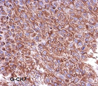 CK20 antibody All the studied cases were CK20 negative in comparison with the positivity of external control (colon).