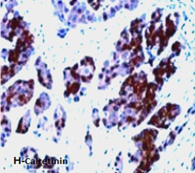 malignant mesothelioma. In these two positive cases, calretinin positive cells showed diffuse moderate to intense staining.