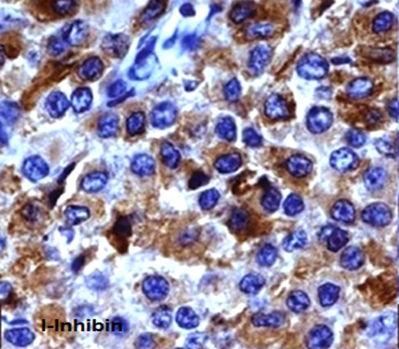 Inhibin-ɑ antibody Two cases were positive for inhibin-ɑ antibody; these two cases were also positive for vimentin and calretinin and negative for AE1/AE3, CK7, CK20, and EMA antibodies.