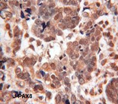 The other negative cases were the four cases showed calretinin positivity (two cases of malignant mesothelioma and the two cases of granulosa cell tumor).