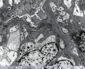 glomerulonephropathy (C, methenamine silver 1,000 and D, electron micrograph, original magnification 8,000), post-infectious glomerulonephritis (E [PAS] and F [C3]) and membranoproliferative