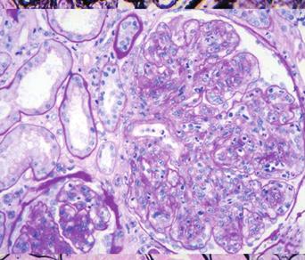 To evaluate the correlation of these histologic findings with their clinical significance, we classified the diabetic nephropathy according to renal histologic patterns, the same as was done in the