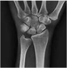 Negative Ulnar Variance Associated with Kienbock s disease (AVN of lunate) due to 100% stress through the radius