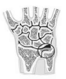com TFCC Diagnosis Classic symptoms are ulnar sided wrist pain that is associated with popping or clicking
