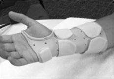 Volar wrist splint between exercise bouts and night for comfort No impact loading.