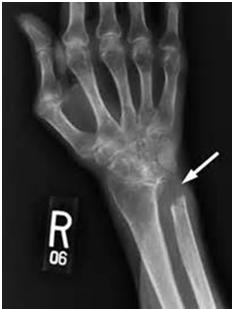 TFCC Repair with Ulnar Shortening (USO) Initially immobilize then mobilize following TFCC repair guidelines Treated as fracture- depends on fixation type Avoid gripping in pronation and resisted