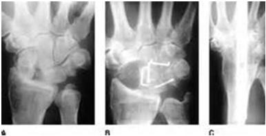 com Hemi-Resection Interposition Intercarpal Arthrodesis Involves the resection of only the articulating portion of the distal ulna and interposing soft tissue to prevent radio-ulnar impingement