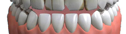 Veneers make teeth look natural and healthy, and because they are very thin and are held in place by a special strong bond (rather like super-glue) very little preparation