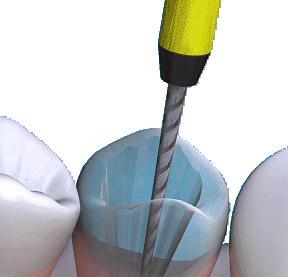 ROOT CNL TRETMENT What is root canal treatment?