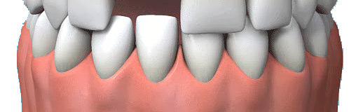In practice, both the false teeth and their supporting rod are known as implants. re implants safe? How long will they last? No.