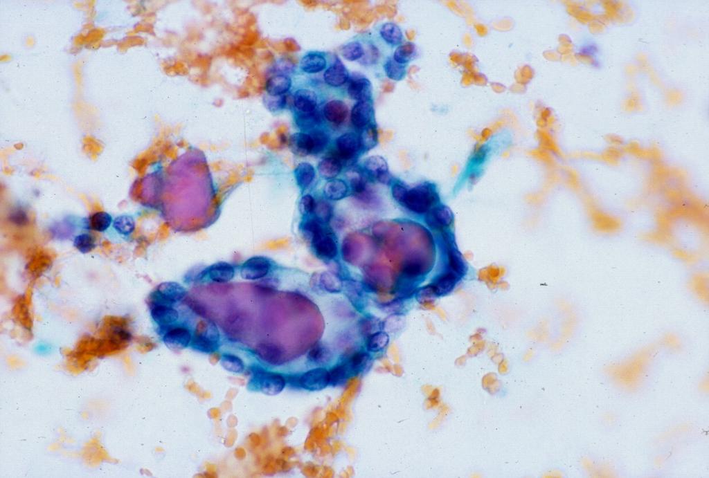 Follicular Variant of PTC: Common Cause of False Negative FNA Diagnosis With