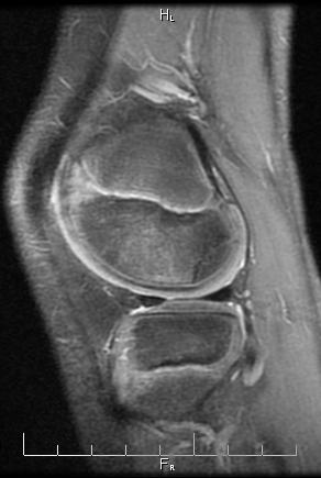 antalgia Radiographs: Only MRI is present today DDX: Ossification variant vs Osteochondritis Dissecans Lesion Discussion: Irregular ossification of the distal femoral epiphysis is common in young