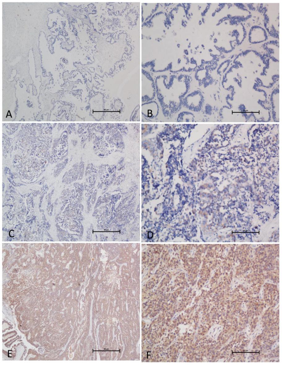 898 Fig 3. GOLPH3L expression as determined by IHC. (A, B) Normal ovarian tissue demonstrated no or low expression of GOLPH3L protein in the cytoplasm of ovarian cells (magnification: A, 40; B, 200).