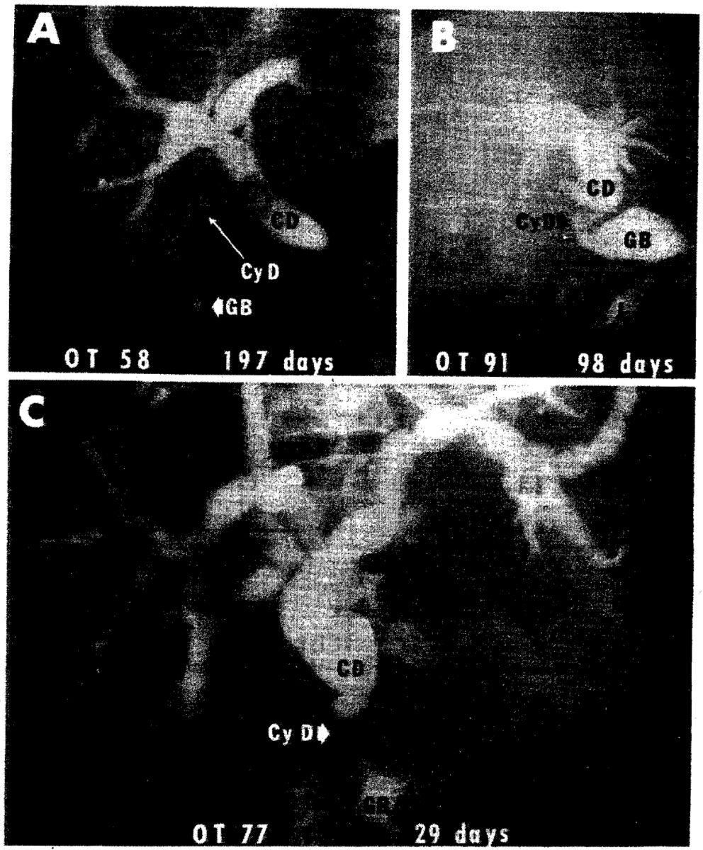 Putnam and Starzl Page 11 Figure 4. Transhepatic cholangiography after liver replacement demonstrating cystic duct obstruction after cholecystoenterostomy.