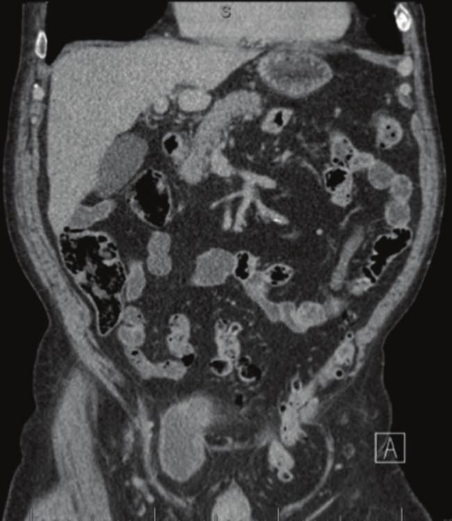 The incidence of primary carcinoma developing within a diverticulum is estimated at 1 10% [13, 14], accounting for roughly 1.5% of bladder cancer [15].