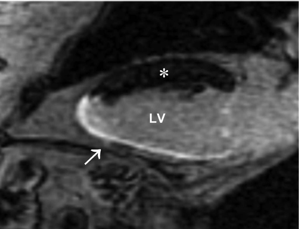 Delayed Enhancement-MRI Images obtained 10-15 15 minutes post-contrast (Gd( Gd) Normal