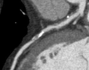 CT angiography Curved MPR