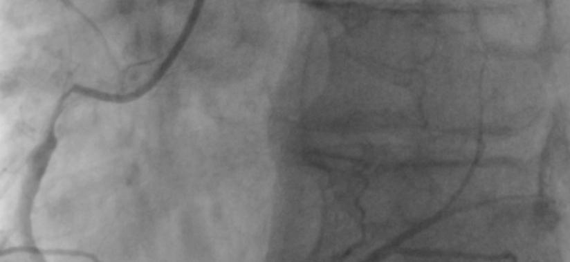 Invasive angiography + FFR Case LP Right 48% FFR: 0.
