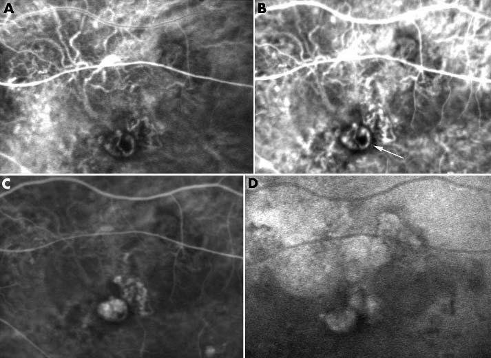 Pulsation was detected in 24 eyes; in only network vessels in 14, in only polypoidal lesions in five, and in both in five. Figure 1 Indocyanine green angiography.