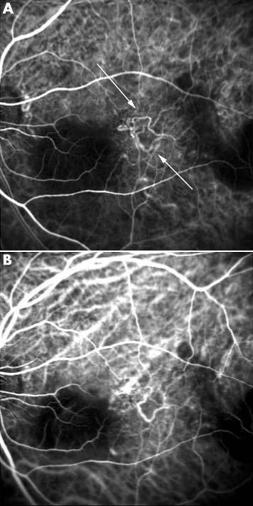 Dilatation is more prominent (arrows) (C, 32 seconds). CNV with polypoidal vascular dilatations.