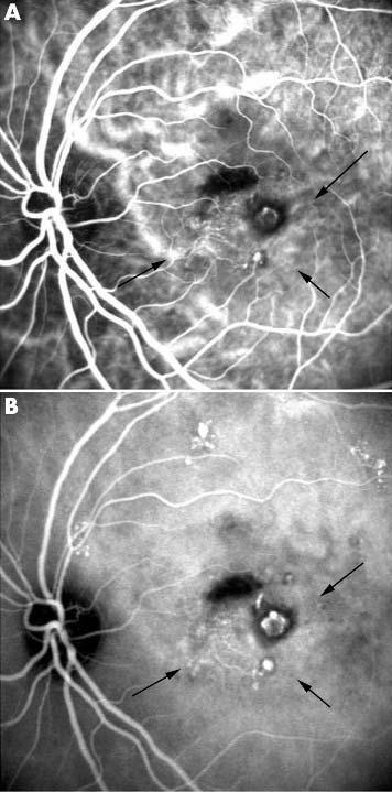 Pulsation suggests branching network vessels arising from the inner choroidal vasculature. Vessels persisting in networks showed focal dilatation, constriction, and tortuousity.