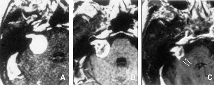 Clinical Neurosurgery Volume 55, 2008 Navigating Change and the Acoustic Neuroma Story FIGURE 6.4. Axial contrast-enhanced MRI showing right-sided acoustic tumor at radiosurgery (A).