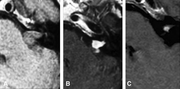 Axial contrast-enhanced MRI showing a 35-year-old man with a left-sided acoustic tumor at radiosurgery (A). Tumor regression is seen at 2 years (B).