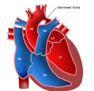 Ductus Arteriosus in Lt sided lesions Ductal Dependency After birth: need the ductus to provide most of