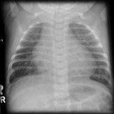 CXR - VSD Management - VSD Diuresis Inotropy with digoxin Surgical repair when optimal Acyanotic CHD Obstructive lesions (Pressure load) Most common are coarctation of the aorta (CoA) 8-10%,