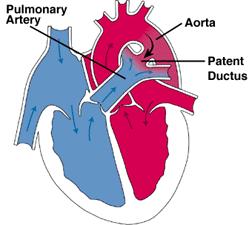 (10mm) allows equalization of Ao and pulm arterial P The Ductus Arteriosus Role of O2 Thick muscular layer Towards late gestation, the muscle layer thickens and the lumen becomes smaller After