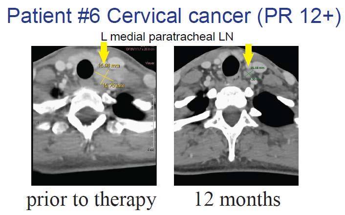 Proof of Concept for MAGE A3 TCR and HPV TCR PR: 85% Tumor Reduction Cervical Cancer Patient 100% Tumor Disappearance Pre-Treatment