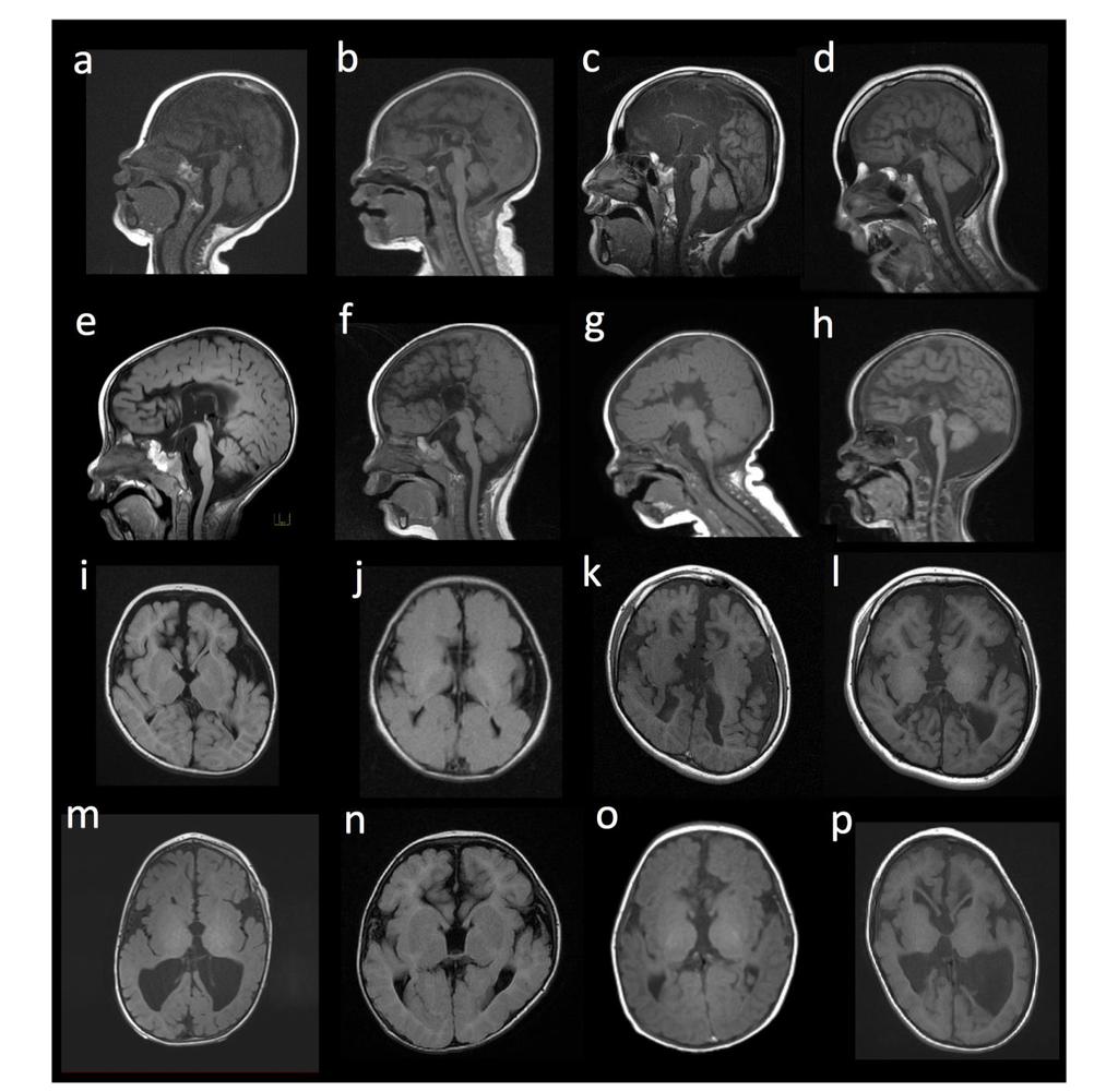 Figure S2. Brain MRI scans of patients. Representative T1-weighted midsagittal and axial images from patient 1.1 at age 5 months (a, i), patient 1.2 at age 4 days (b, j), patient 2.