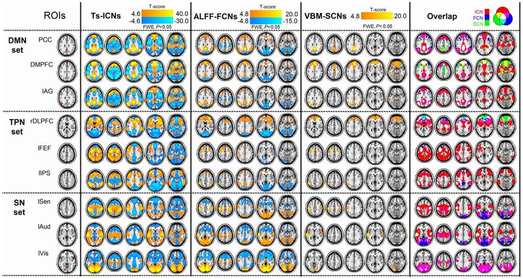 Figure 1. Brain network pattern mapped by ALFF-FCN, TS-ICN and VBM-SCN techniques. All ALFF-FCNs, TS-ICNs and VBM-SCNs showed significantly positive correlation (warm color).