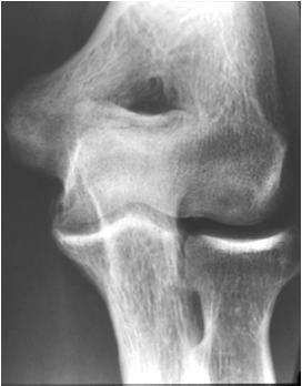 COMMON SPORTS INJURIES of the ELBOW Articular Plica Osteophyte