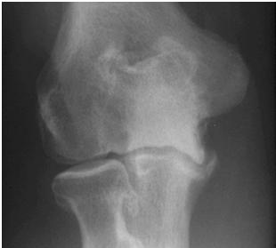 Osteochondritis of the Elbow When to