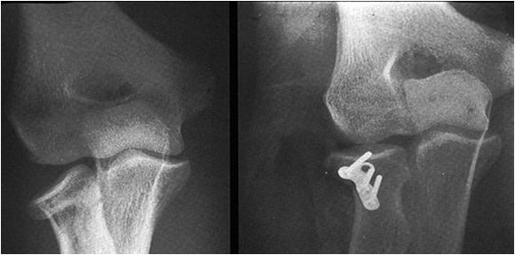 Radial Head Fracture in the Athlete