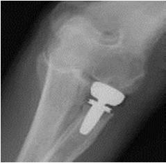 Fracture of the Radial Head Resection Author Yr No FU/yr Sat/% Comment Morrey 1976 34 20 88 all Type lll Wallenbeck 1997 27 17 81 lll,lv- poorer Janssen 1998 20 23 95 all Type lll Sanchez-Sotelo 2000