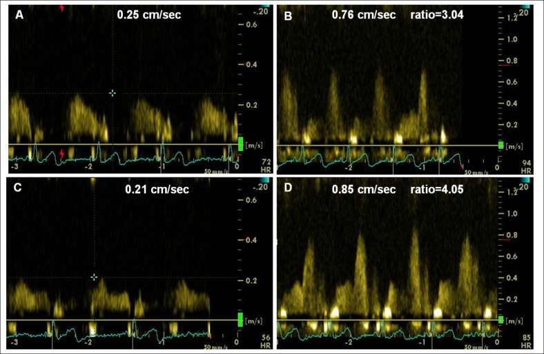 An example of transthoracic Doppler echocardiography images in a single patient LAD baseline (A) and maximal at 110μg/kg/min adenosine infusion rate (B) CBFV recorded at Day 15 while under prasugrel.
