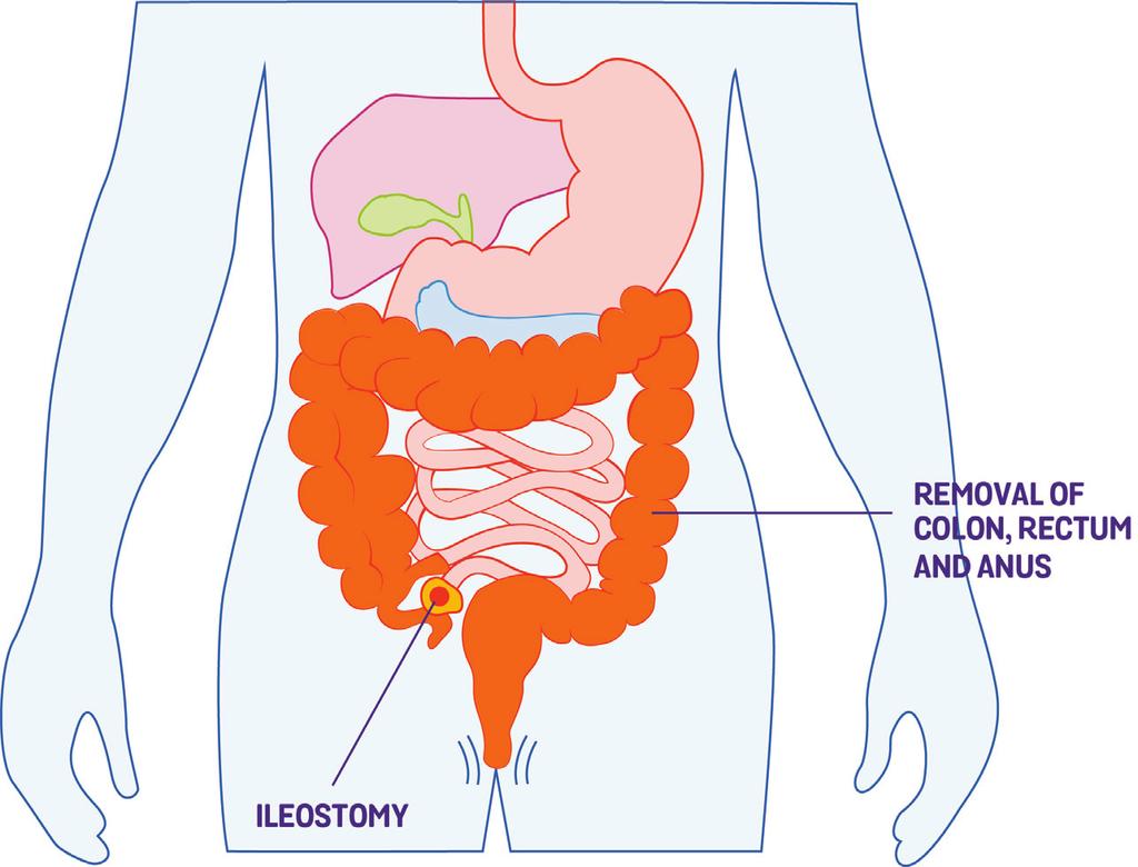 Proctocolectomy with ileostomy In this operation the entire colon is removed, together with the rectum and the anal canal.