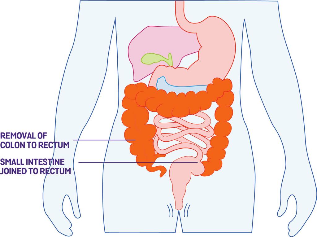 This can be emptied or changed as necessary (see Stomas below). This surgery is irreversible, but means that you no longer have a colon to become inflamed or develop bowel cancer.