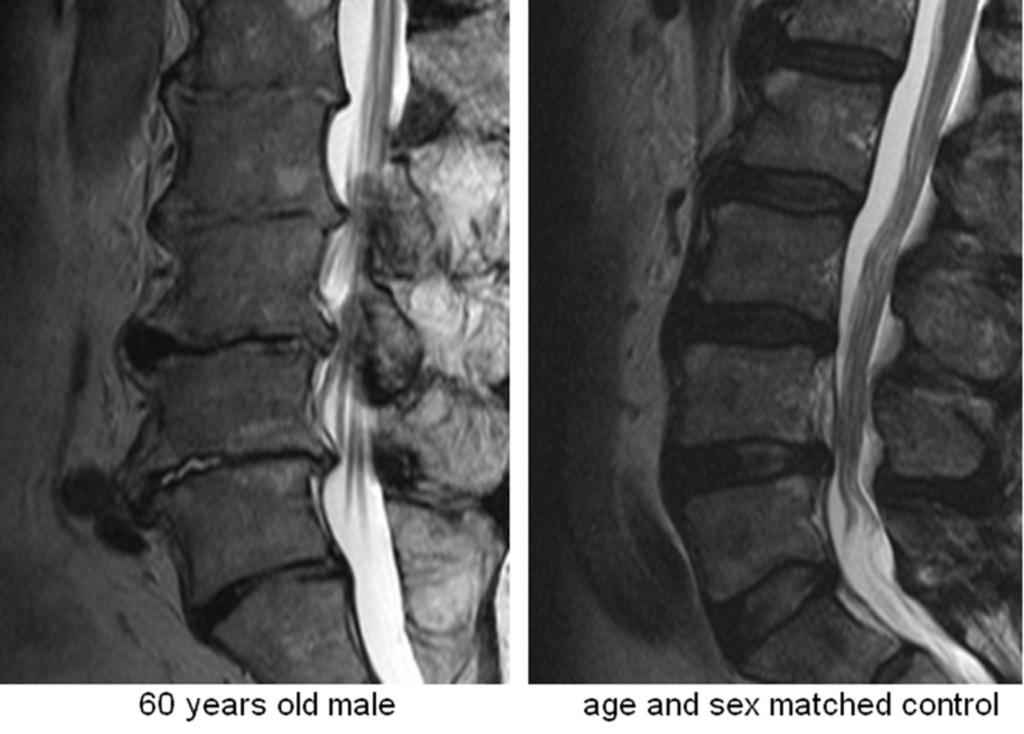 Fig. 1: T2 weight MR images: (left) 60 years old