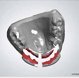 The laboratory scans the model and designs the abutment using 3Shape Abutment Designer. 5.
