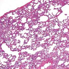 Cellular interstitial infiltrates. Lymphocytes, plasma cells, and macrophages are present in the alveolar walls Airspace filling.